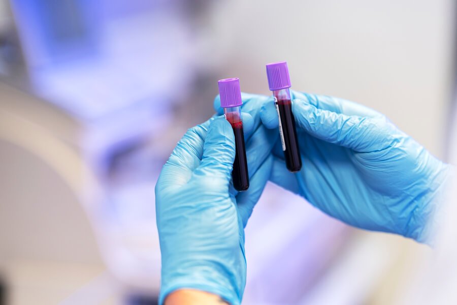Servicio de hematopatologia - Manos con guantes sosteniendo dos viales de sangre